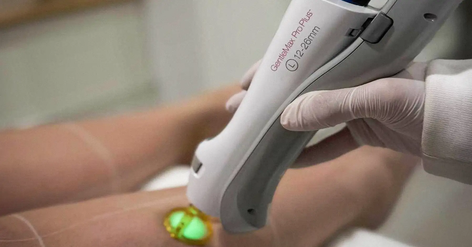 GentleMax Pro Plus Laser Ontharen